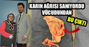 Karın Ağrısı Vardı, Vücudundan Kist Çıktı