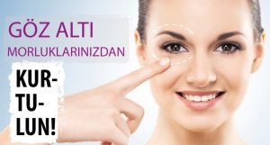 Göz Altı Morlukları Nasıl Geçer?