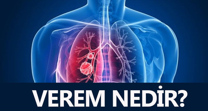 Verem Nedir?