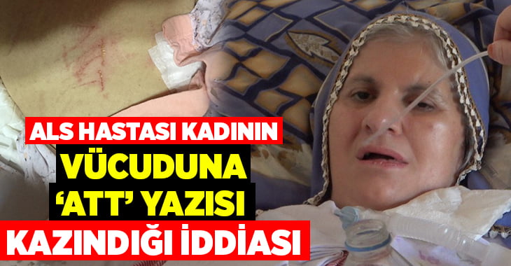 Denizli’de yatalak ALS hastasının karnına tırnakla ‘ATT’ yazıldı iddiası