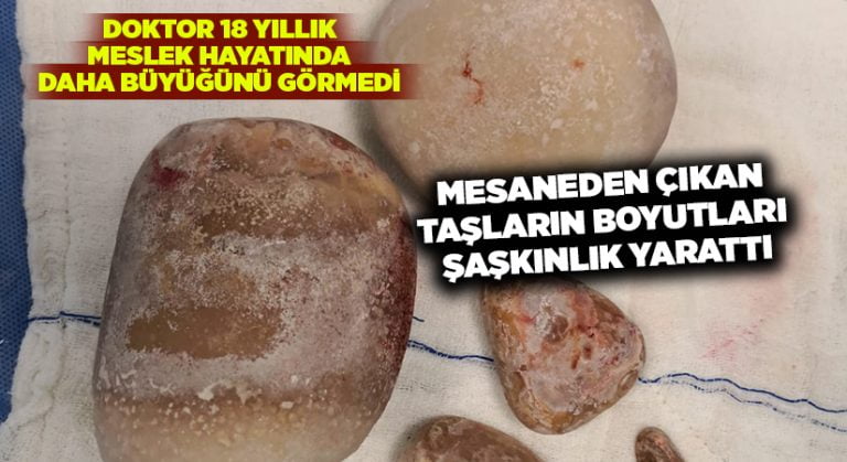 Mesaneden Çıkan Taşlar Boyutları İle Şaşkınlık Yarattı